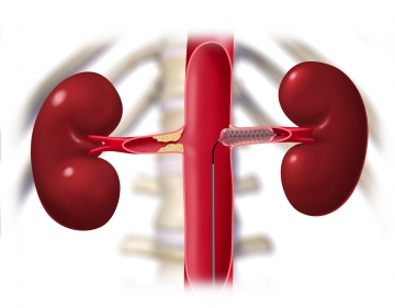 Deploying the balloon-expandable stent in the left renal artery