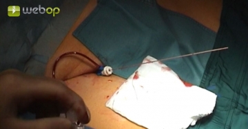 Puncturing the right common femoral artery