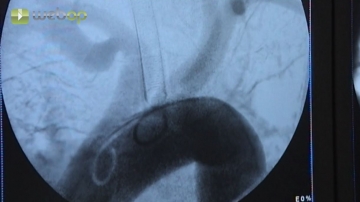 Overview angiogram of the aortic arch