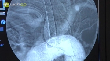 Probing the right common carotid artery