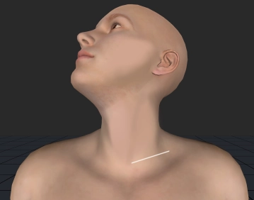 Acceso supraclavicular izquierdo