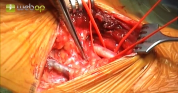 Preparación de la arteria carótida común