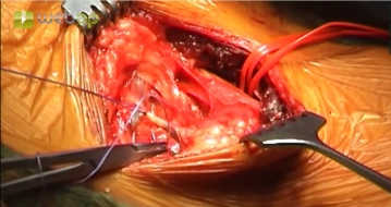 Ligadura y transección de la vena yugular externa