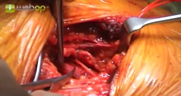 Sección del músculo escaleno anterior