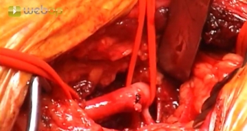 Präparation der Arteria subclavia