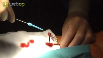 Punción de la arteria femoral común derecha