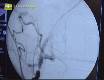 Paso de las estenosis con un alambre Terumo®