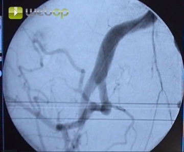 Inserción de un catéter pigtail