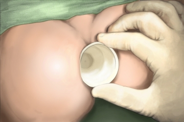 Verifying the indication and dilating the anal sphincter