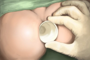 Review of the indication and dilation of the anal sphincter