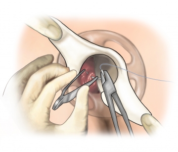 Purse string suture