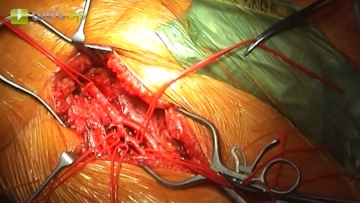 Preparación de la bifurcación femoral