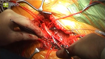 Pinzamiento de la bifurcación femoral y arteriotomía