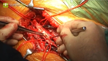 TEA de la bifurcación femoral