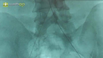 Accesos transfemorales bilaterales, sondaje de la aorta