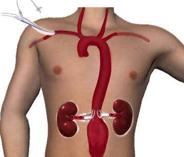 Sondaje de las arterias renales