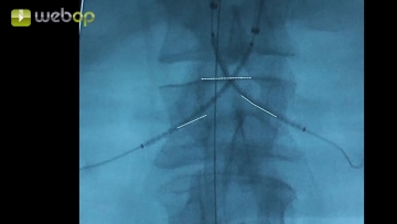 Implantation der renalen Chimney-Stent-Grafts	