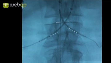 Implantación de los stent-grafts chimney renales