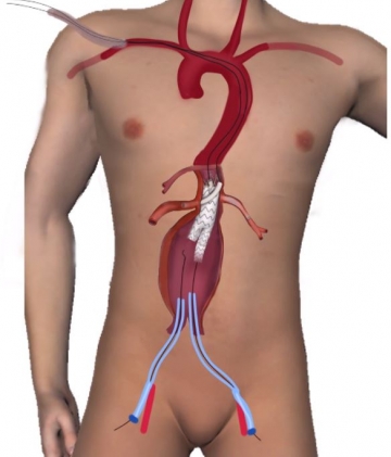 Implantation des Aorten-Stent-Grafts von links transfemoral