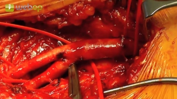 Preparación de la bifurcación femoral