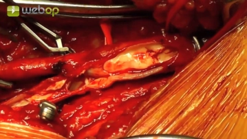 Pinzamiento de la bifurcación femoral y arteriotomía