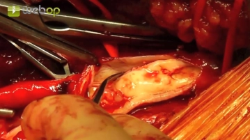 TEA de la bifurcación femoral