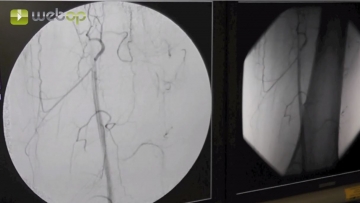 Angiographie zur Vorbereitung der AFS-Dilatation