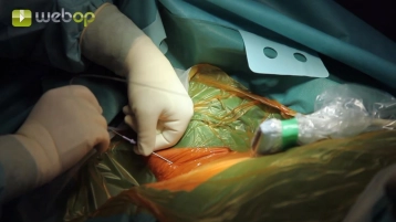 Punción de la vena yugular interna derecha