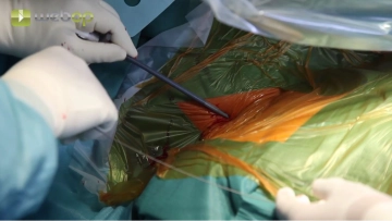 Introducción de la vaina peel-away