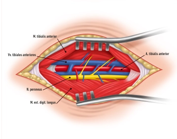 Preparación y pinzamiento de la Arteria tibial anterior