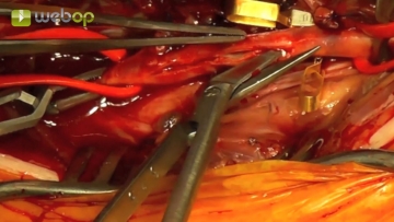 Inzision der Arteria tibialis anterior