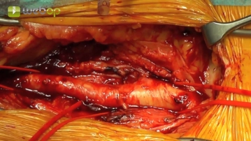 Preparación de la bifurcación femoral en la ingle izquierda