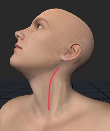 Acceso cervical izquierdo