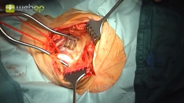 Preparación de la ACC