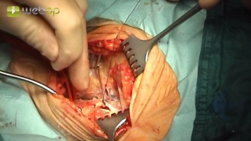 Ligadura de la vena facial, transección parcial del músculo digástrico