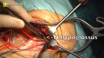 Preparación de la ACE y ACI, Movilización del nervio hipogloso