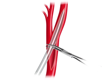 Inserción intraluminal de shunt