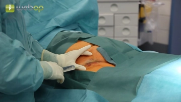 Punción de la arteria femoral común derecha