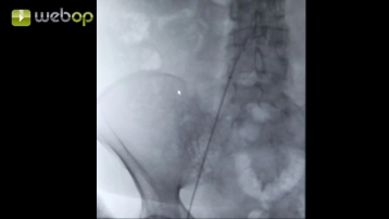 Introducción de la vaina hasta el arco aórtico