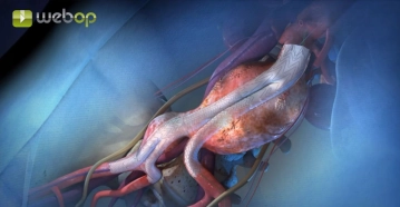 Principio del procedimiento endovascular