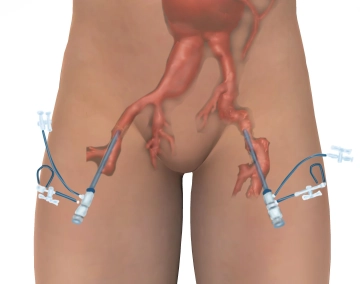 Acceso inguinal bilateral