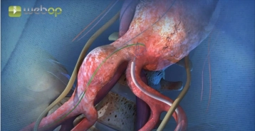 Introducción y preposicionamiento del componente de rama ilíaca