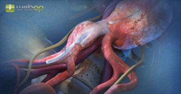 Despliegue parcial del componente de rama ilíaca