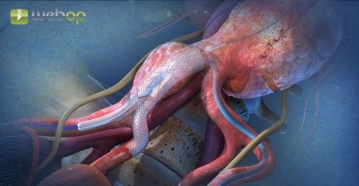 Einführen eines Verlängerungsmoduls in die Arteria iliaca interna, komplette Entfaltung der iliakalen Branch-Komponente