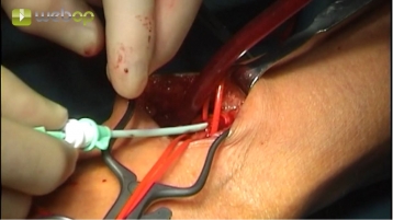 Punktion der Arteria brachialis links in Seldinger-Technik