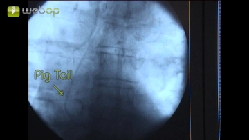 Colocación de un catéter pigtail