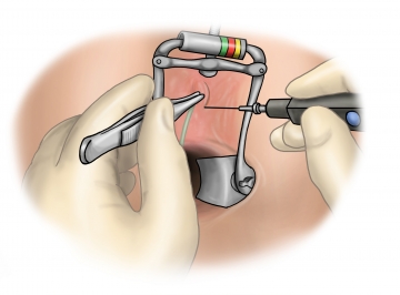 Excising the fistula opening