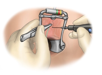 Excision of the fistula opening