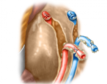 Managing the inferior mesenteric artery