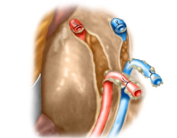 Managing the inferior mesenteric artery
